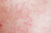 Skin with Redness and Visible Vessels